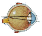eye astigmatism
